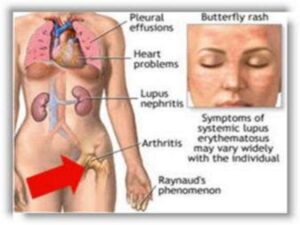 Lupus Hastalığı nedir?Lupus Hastalığının Sebepleri nelerdir?