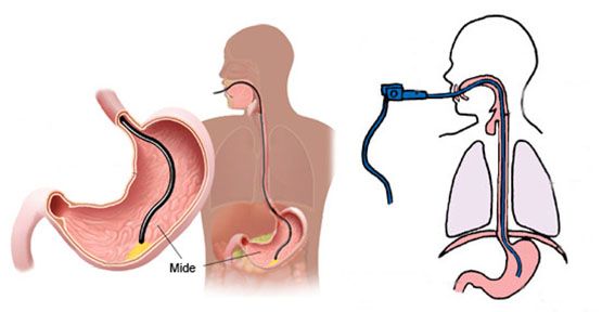  Endoskop,hastaların vücutlarındaki girintilerin doktor tarafından  video ekranında incelenmesine olanak veren