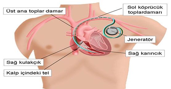  Kalp pili, toplardamar yoluyla kalbe giden sensörlü  kablolara  bağlı ,