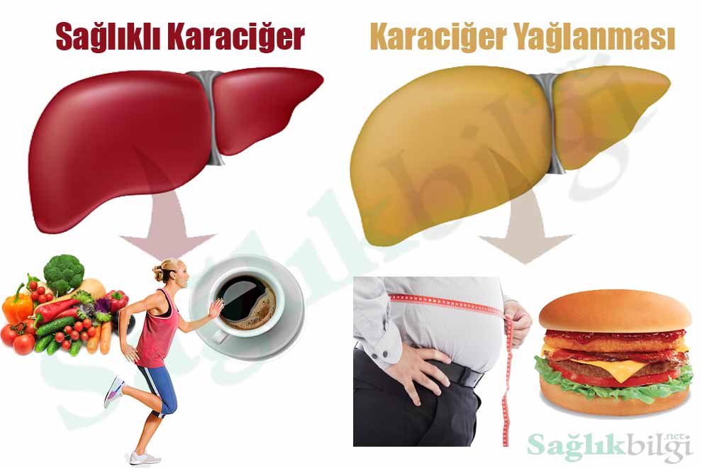 Karaciger yaglanması (hepatosteatoz) ; karaciger hücrelerinde aşırı yağ birikmesidir. Yetişkin