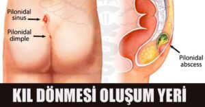 Kıl Dönmesi Nasıl Oluşur ? Nerelerde Oluşur ?