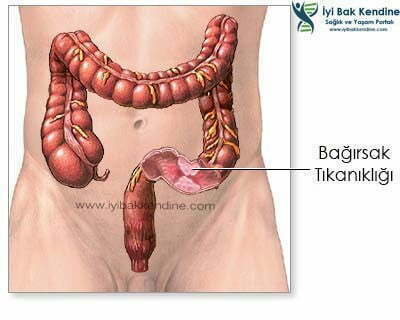 bağırsak tıkanması