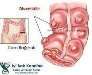 divertikül iltihabı divertikülit