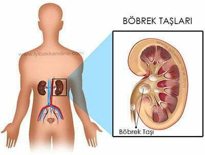 Böbrek taşı görüntüsü