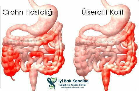 crohn hastalığı kron