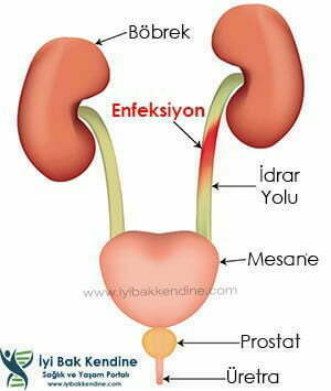 idrar yolu enfeksiyonu